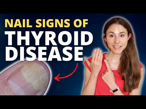 NAIL SIGNS OF THYROID DISEASE 💅 DERMATOLOGIST @Dr Dray